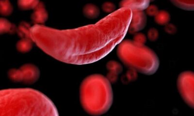 Hydroxyurea Reduces Infections In Children With Sickle Cell Anemia, New Study Shows