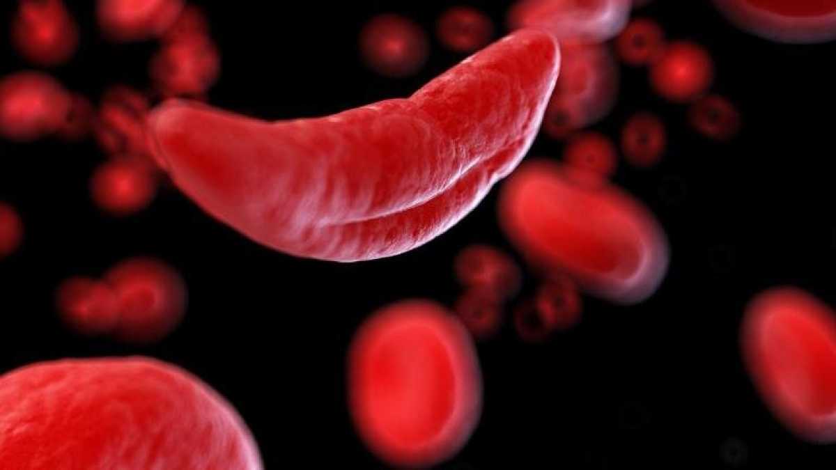 Hydroxyurea Reduces Infections In Children With Sickle Cell Anemia, New Study Shows