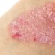 Pediatric Patients With Psoriasis Show Significant Improvement With Apremilast Treatment, Phase 3 Trial Finds