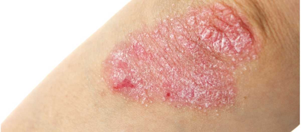 Pediatric Patients With Psoriasis Show Significant Improvement With Apremilast Treatment, Phase 3 Trial Finds