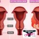 Cervical Cancer: The Silent Killer Understanding The Disease And Its Implications