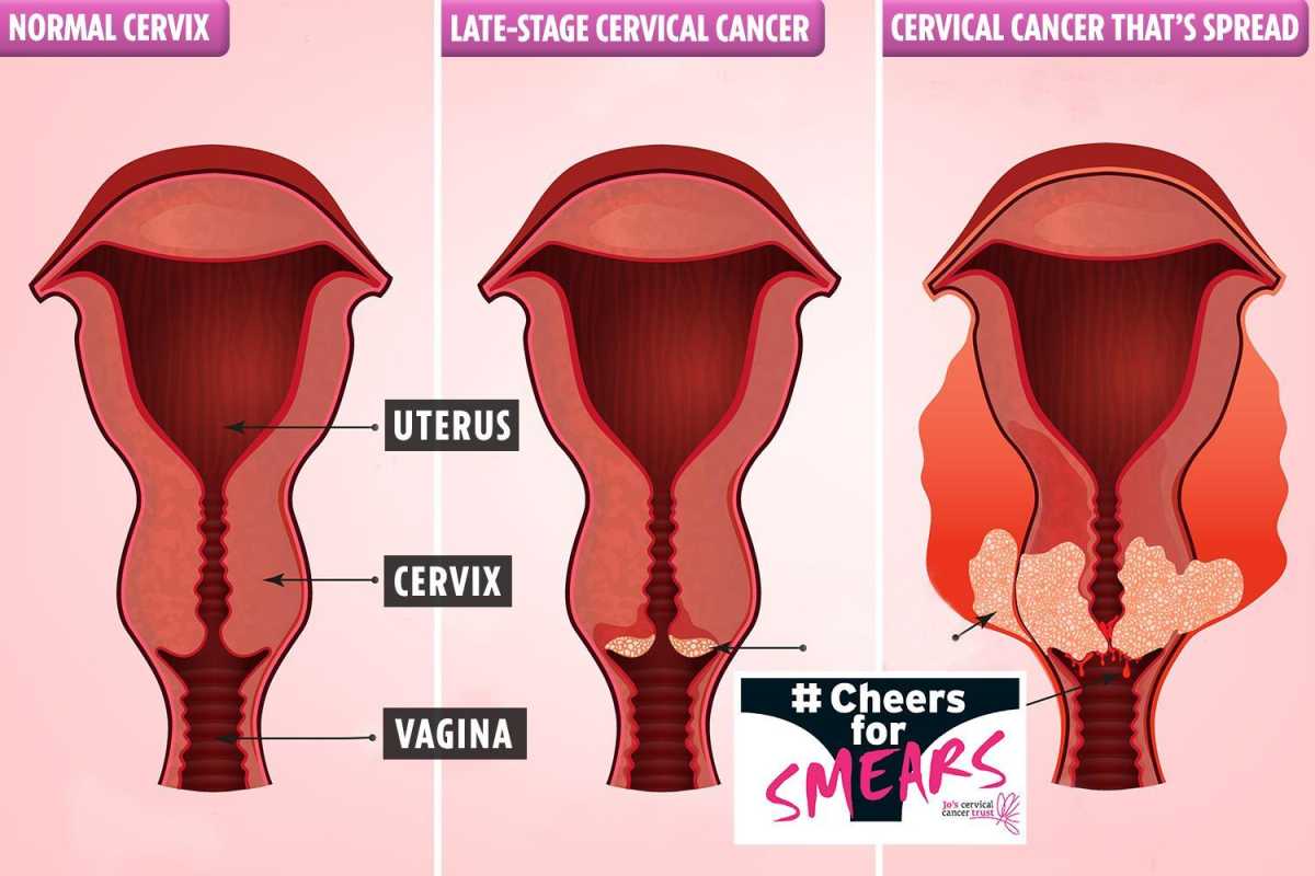 Cervical Cancer: The Silent Killer Understanding The Disease And Its Implications