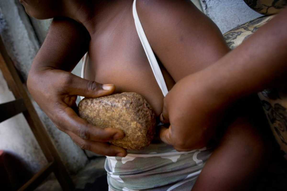 Harmful Practice Of Breast Ironing Affects Millions Of Women In Africa