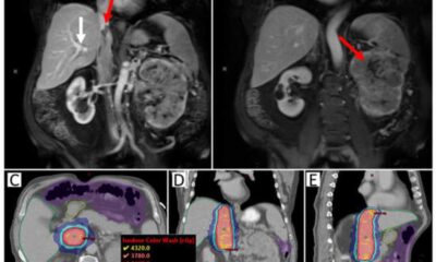 Samurai Trial: Investigating Sabr For Metastatic Rcc Patients Receiving Immunotherapy