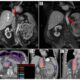 Samurai Trial: Investigating Sabr For Metastatic Rcc Patients Receiving Immunotherapy