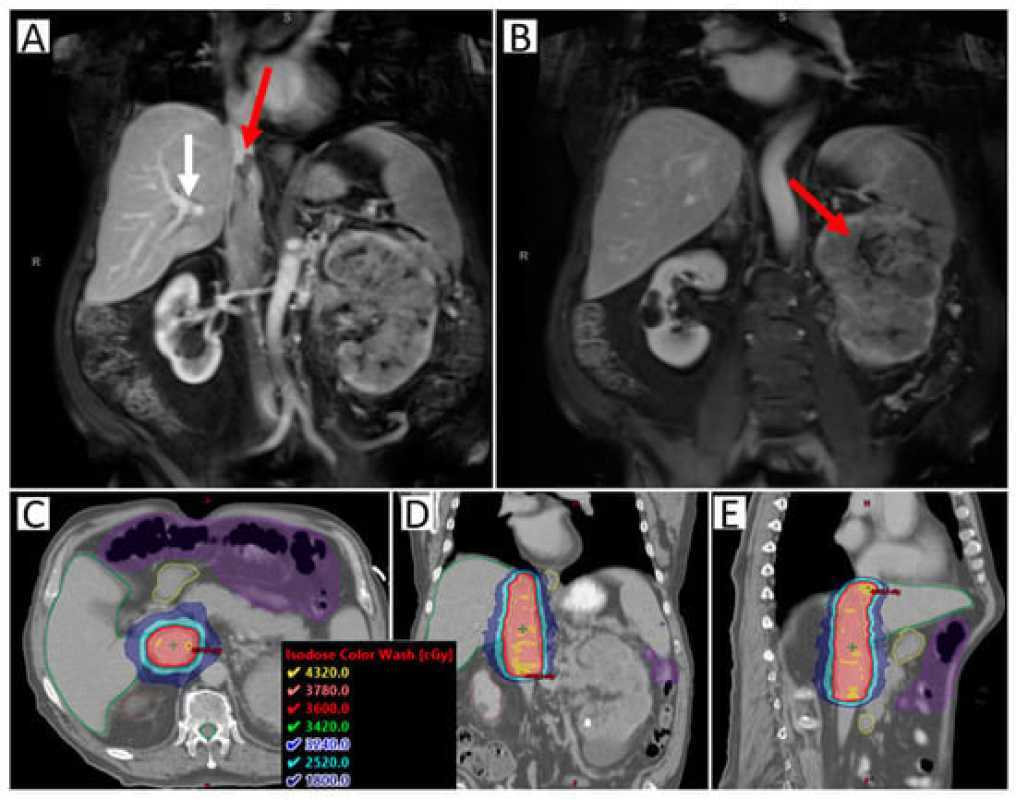 Samurai Trial: Investigating Sabr For Metastatic Rcc Patients Receiving Immunotherapy