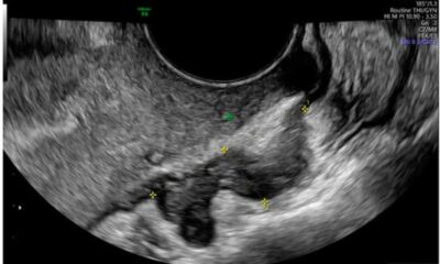 Study Reveals Causal Relationship Between Gut Microbiota And Endometriosis