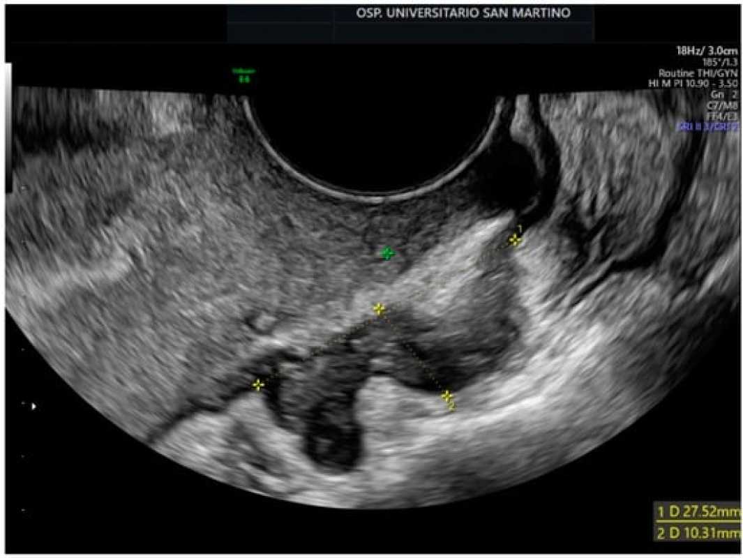 Study Reveals Causal Relationship Between Gut Microbiota And Endometriosis