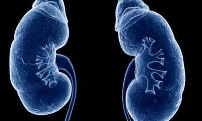 Study Reveals Insights Into Nephrotic Syndrome: Causes, Symptoms, And Treatment Options Explored