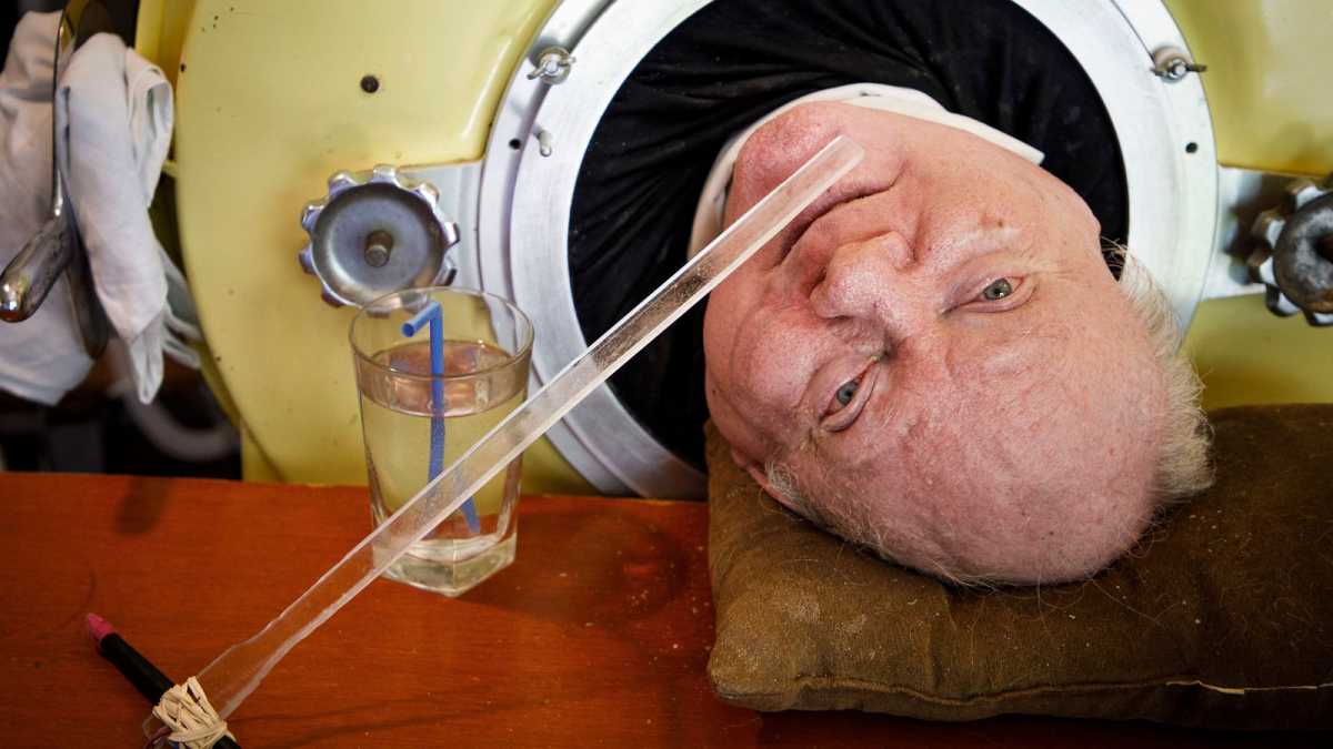 Polio Survivor 'man In The Iron Lung' Passes Away After 70 Years