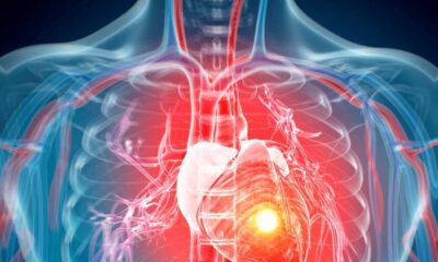 Study Reveals Link Between Lupus Nephritis And Cardiovascular Risk In Sle Patients