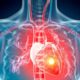 Study Reveals Link Between Lupus Nephritis And Cardiovascular Risk In Sle Patients