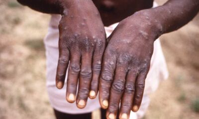 Mpox Outbreak Prompts Emergency Declaration