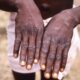 Mpox Outbreak Prompts Emergency Declaration