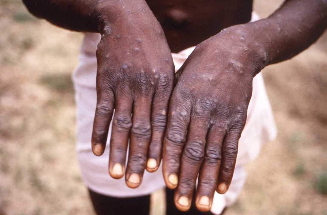 Mpox Outbreak Prompts Emergency Declaration