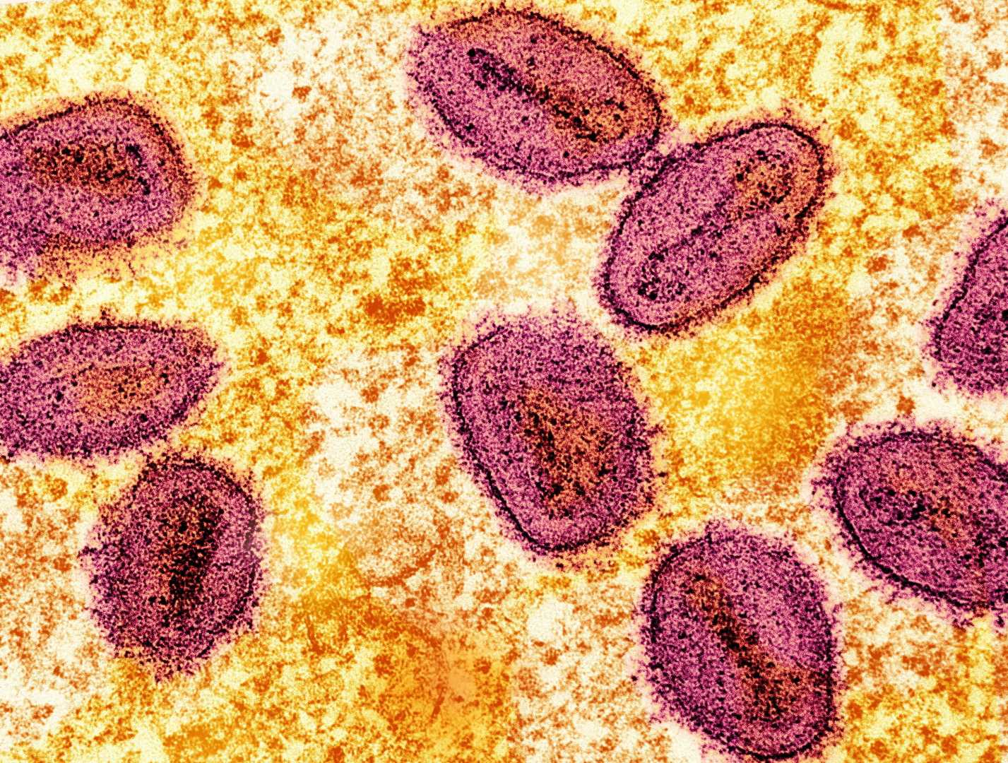 Mpox Clade 1b Strain