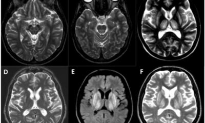 Wilson's Disease Mri