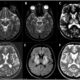 Wilson's Disease Mri