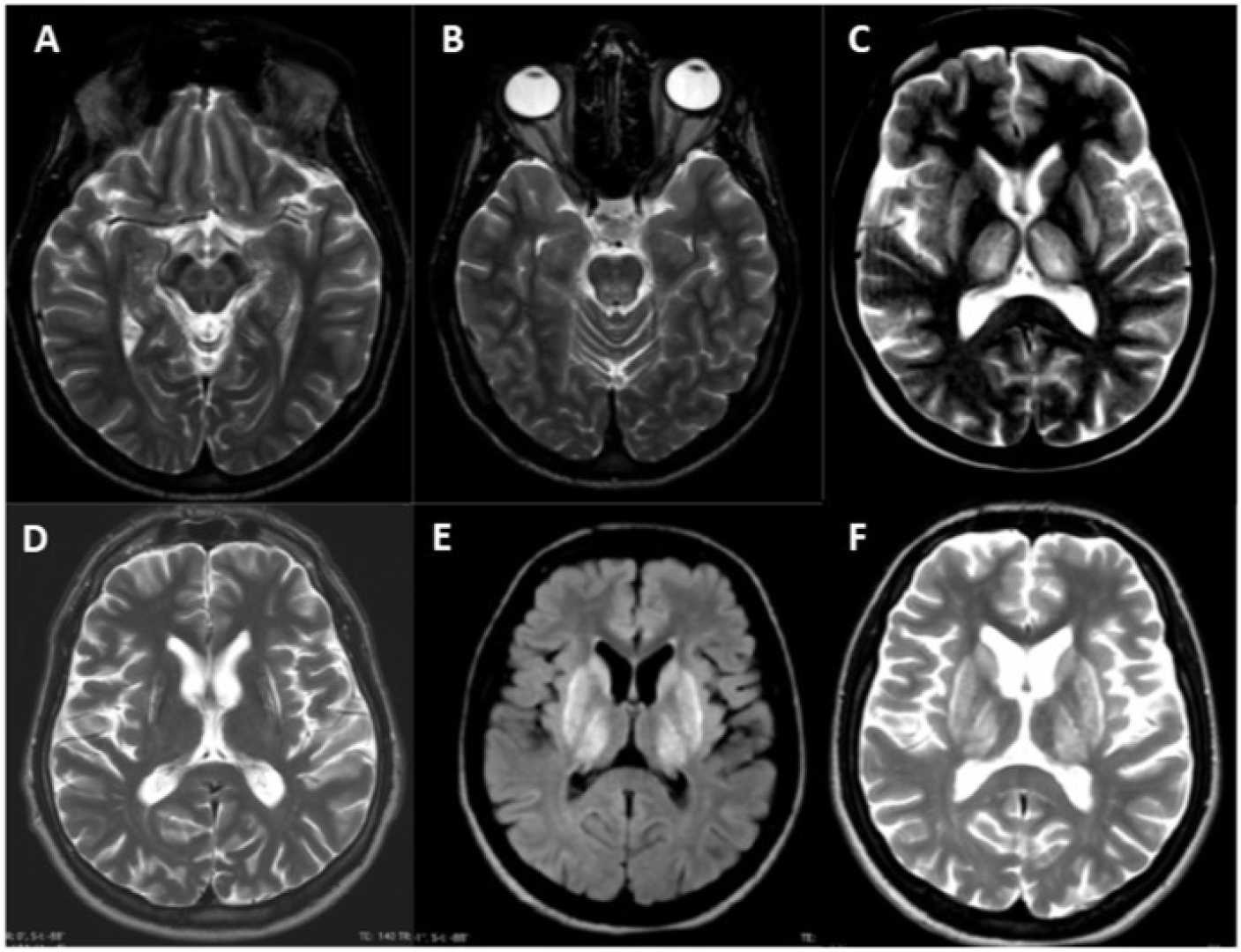 Wilson's Disease Mri