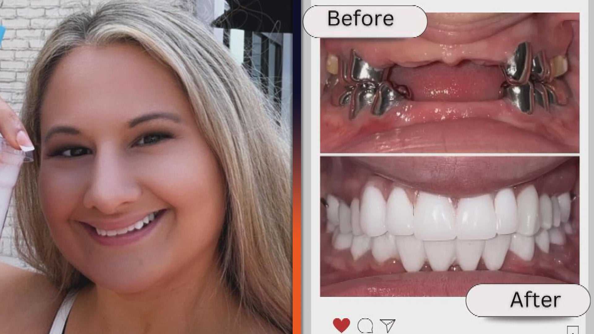 Gypsy Rose Blanchard Teeth Makeover