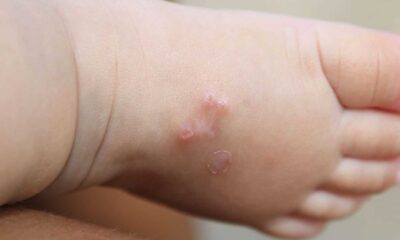 Scabies Rash Symptoms