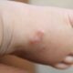 Scabies Rash Symptoms