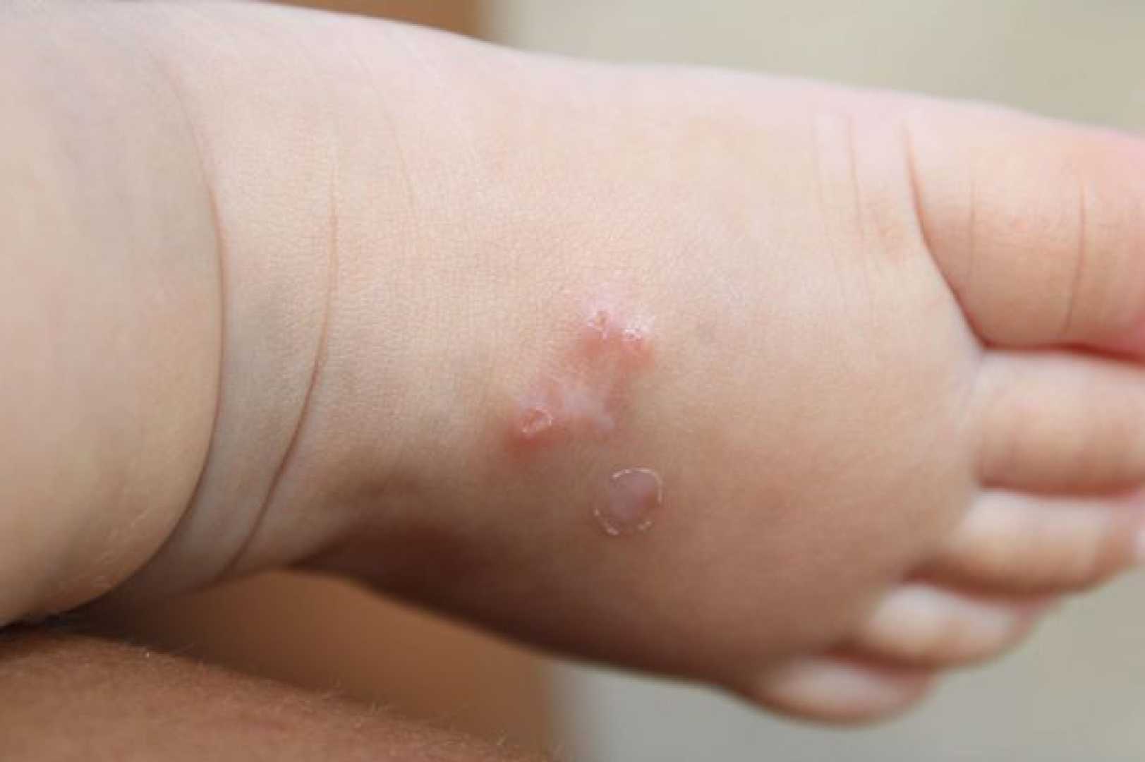 Scabies Rash Symptoms