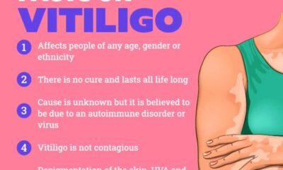 Vitiligo Treatment