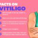 Vitiligo Treatment