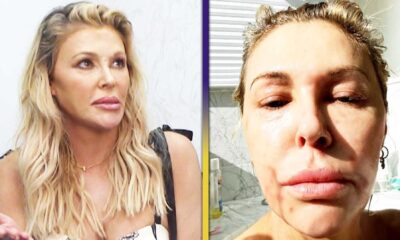 Brandi Glanville Facial Disfigurement