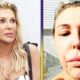 Brandi Glanville Facial Disfigurement