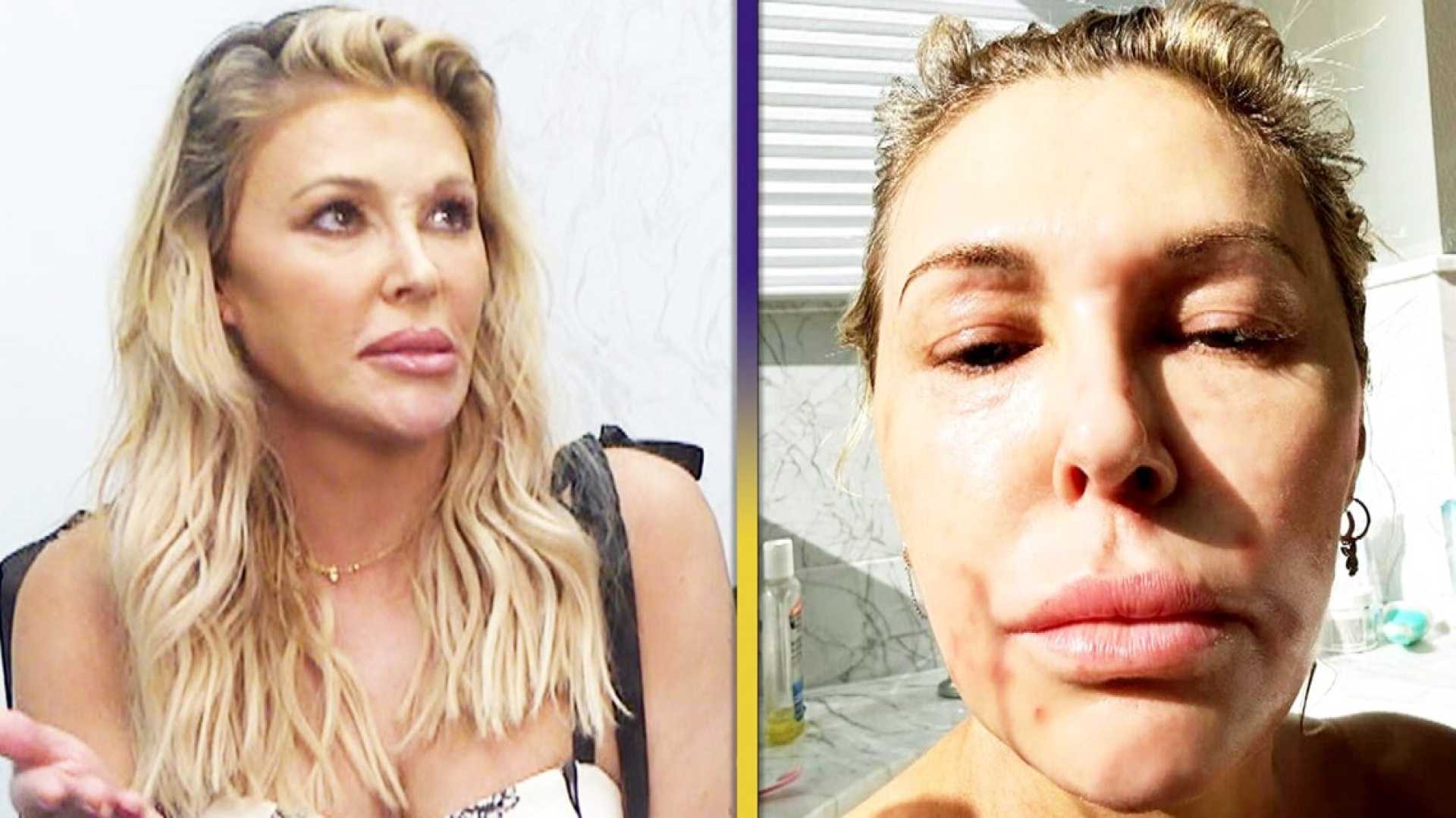 Brandi Glanville Facial Disfigurement