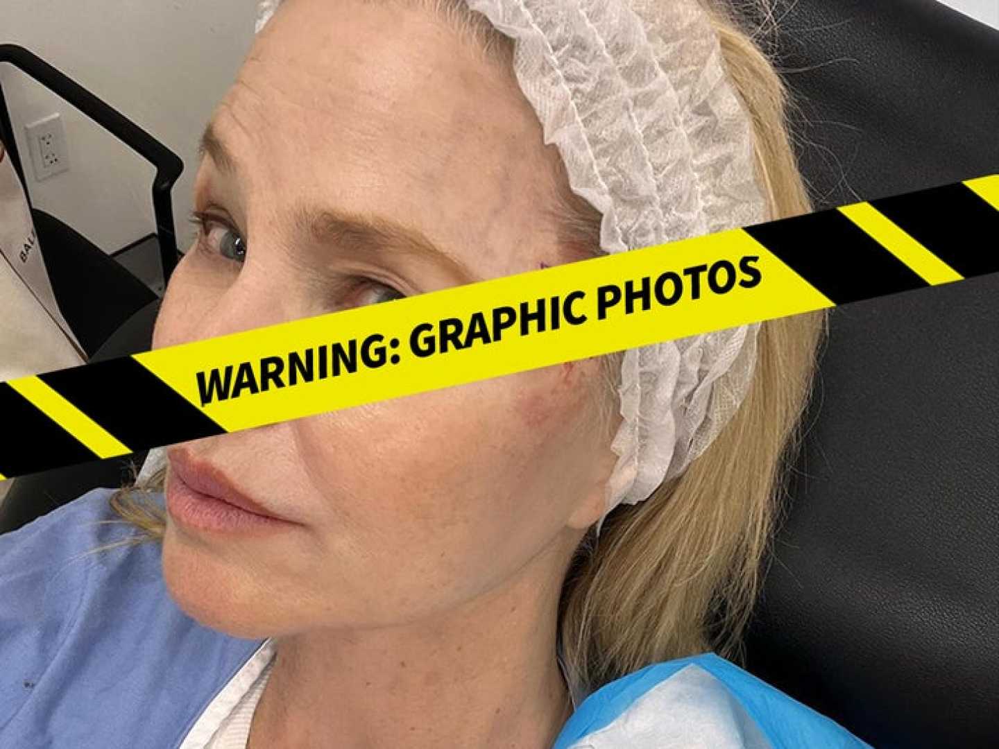 Christie Brinkley Basal Cell Carcinoma Diagnosis