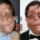 Adam Pearson Neurofibromatosis Type 1