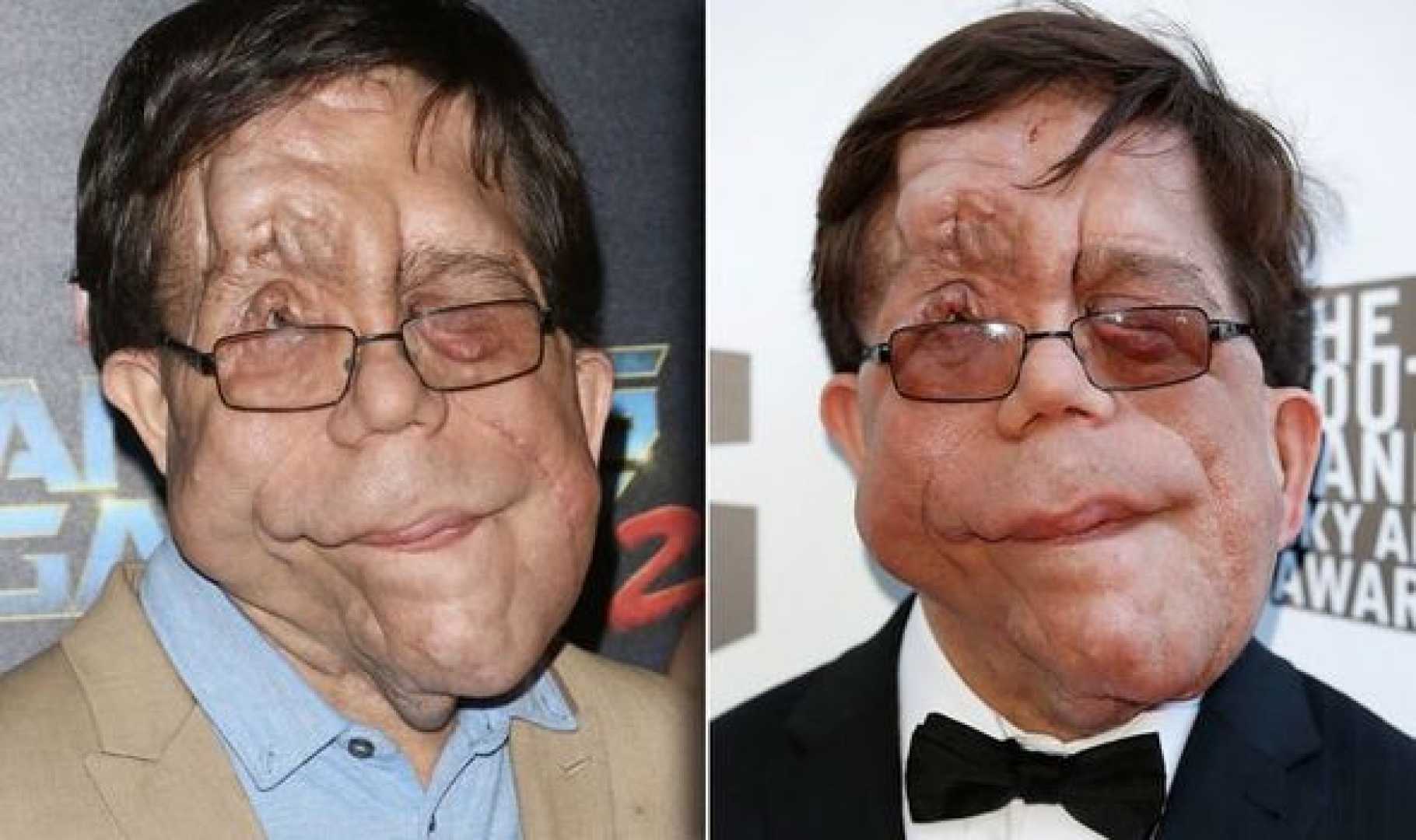 Adam Pearson Neurofibromatosis Type 1