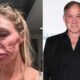 Brandi Glanville Facial Biopsies Dr. Dubrow