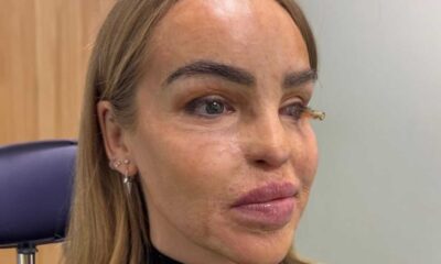 Katie Piper Prosthetic Eye Surgery Hospital