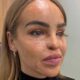 Katie Piper Prosthetic Eye Surgery Hospital