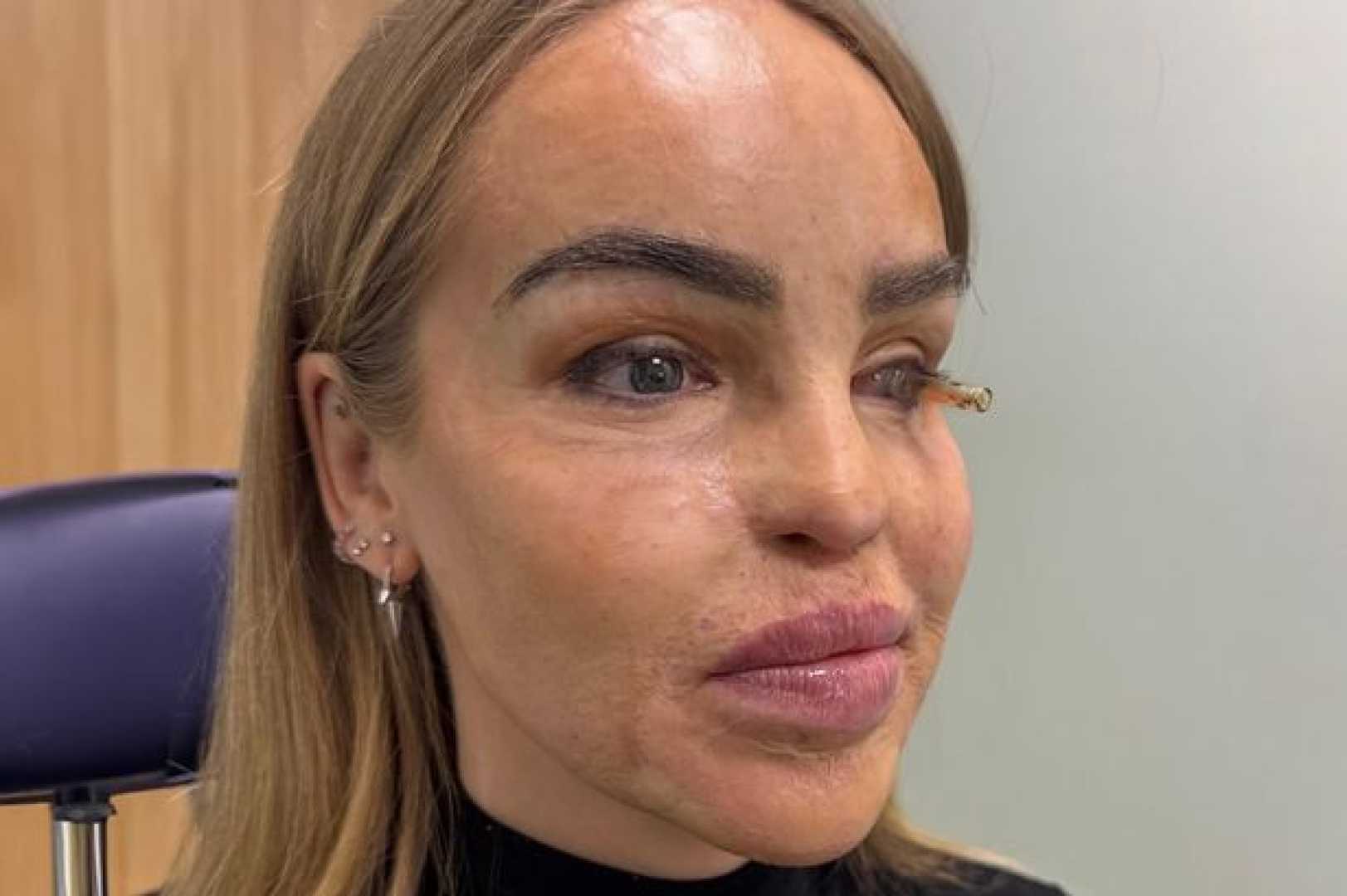 Katie Piper Prosthetic Eye Surgery Hospital