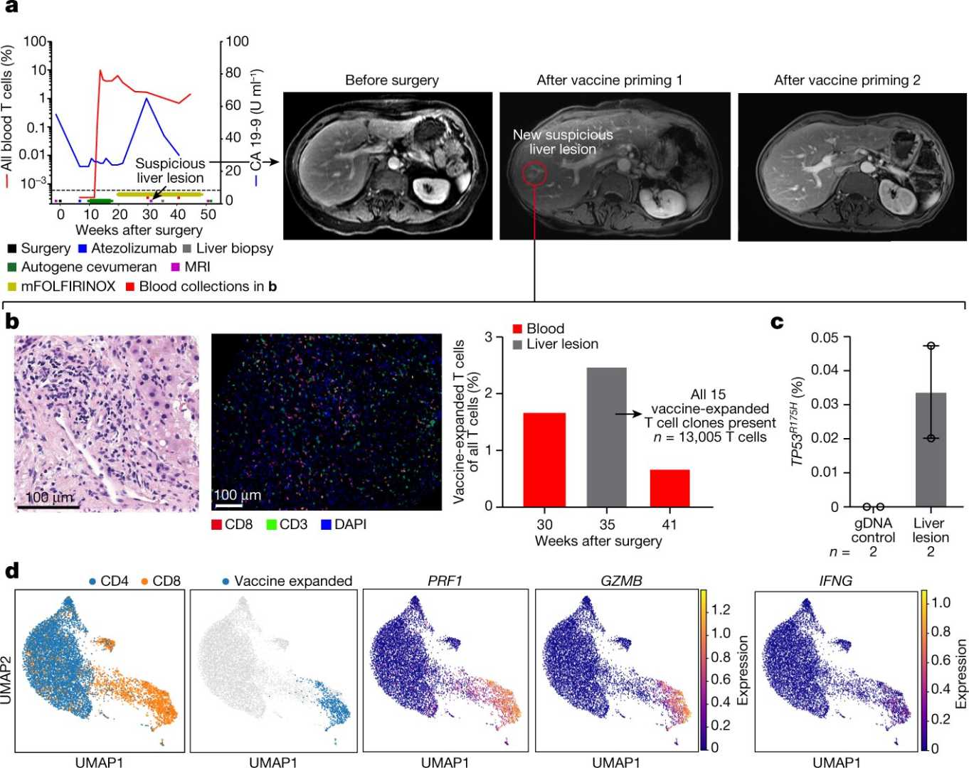 Mrna Vaccine Pancreatic Cancer Trial