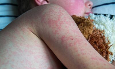 Texas Measles Outbreak School Children