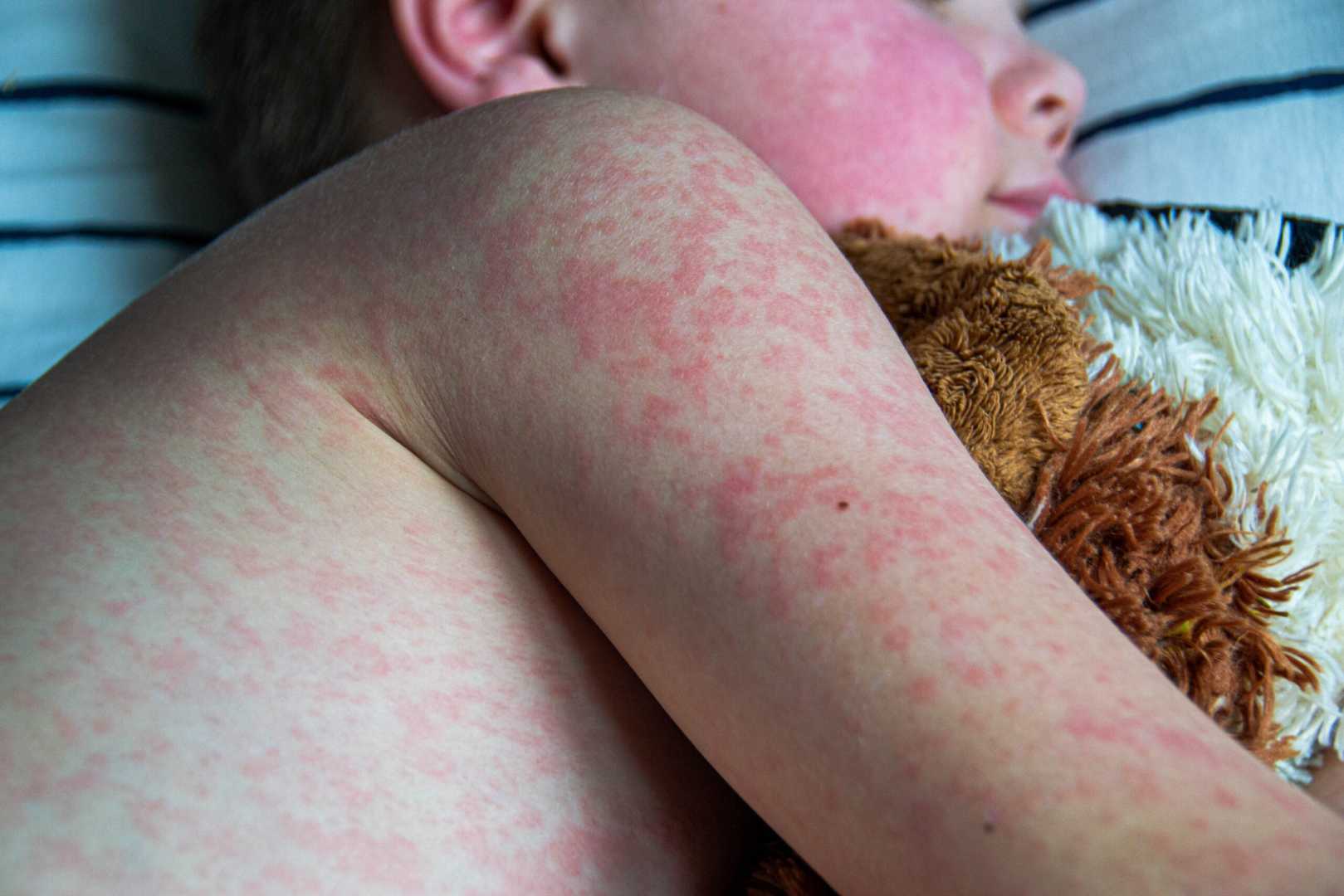 Texas Measles Outbreak School Children