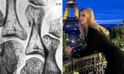 Ivanka Trump Paris Vacation Injury X Ray