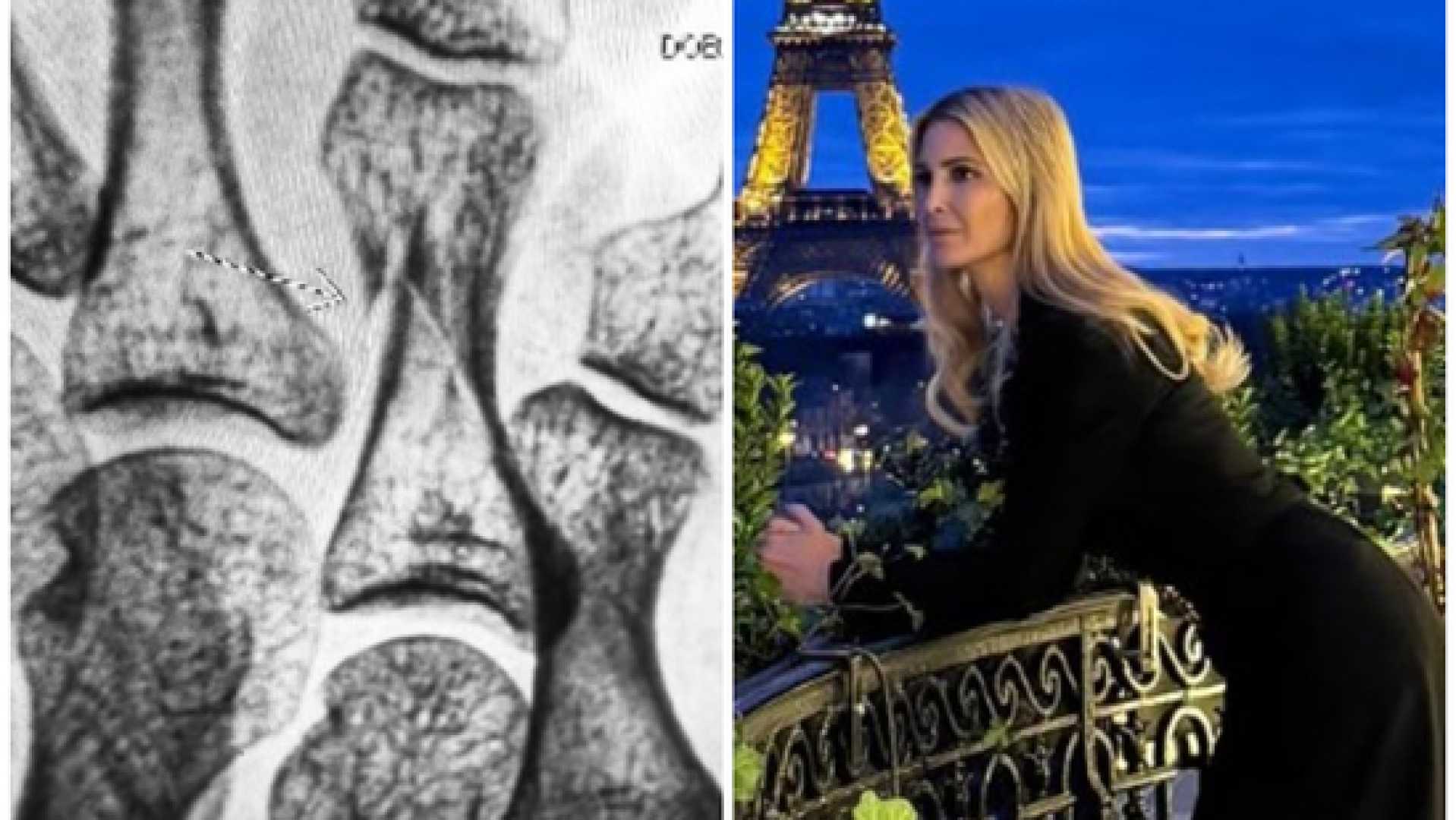 Ivanka Trump Paris Vacation Injury X Ray