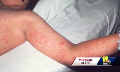 Measles Outbreak Maryland Health News