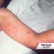 Measles Outbreak Maryland Health News