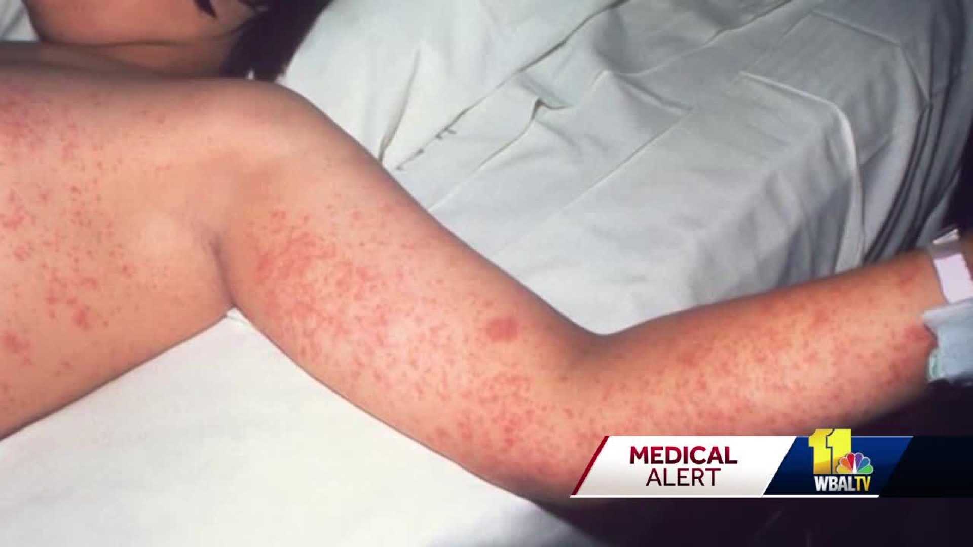 Measles Outbreak Maryland Health News