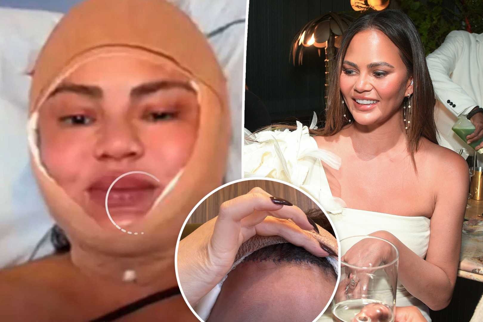 Chrissy Teigen Hospital Hairline Procedure