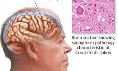Contaminated Human Growth Hormone Creutzfeldt Jakob Disease