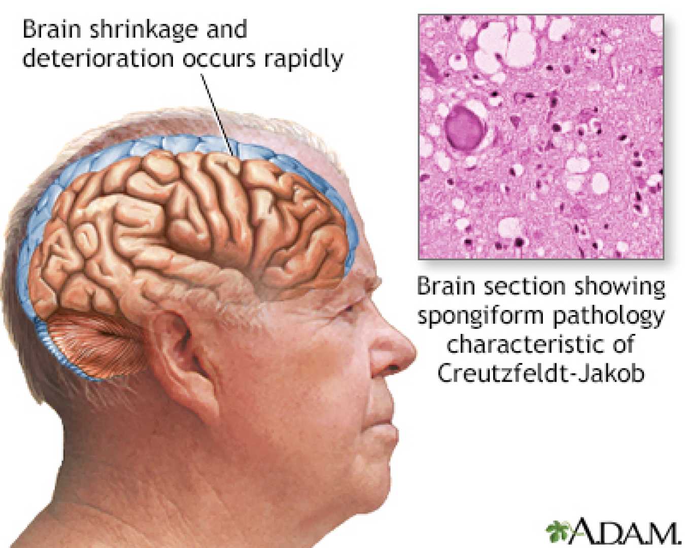 Contaminated Human Growth Hormone Creutzfeldt Jakob Disease